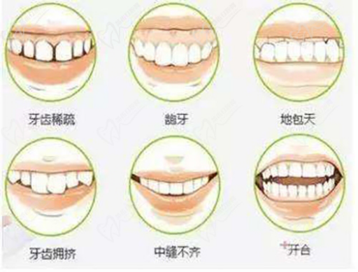 龈下刮治好吗（龈下刮治为什么要好几次）